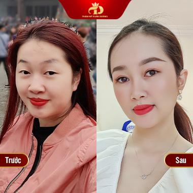 Cắt mí ở Vĩnh Yên