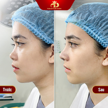 Nâng mũi đẹp ở Vĩnh Phúc