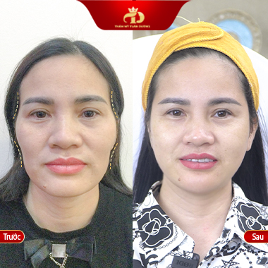 điều trị má hóp thái dương lõm đẹp an toàn ở vĩnh phúc