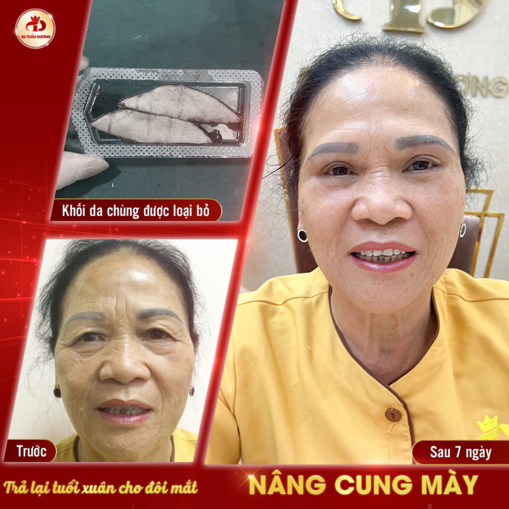 Nâng cung mày ở Vĩnh Yên Vĩnh Phúc
